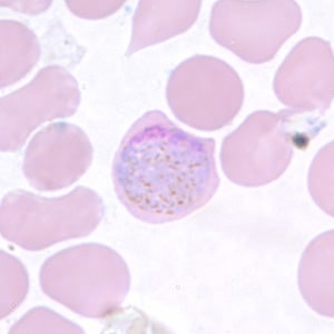 Pv_gametocyte_thinD.jpg Figure F: Macrogametocyte of <em>P. vivax</em> in a thin blood smear. Note the enlargement of the gametocytes compared to uninfected RBCs.