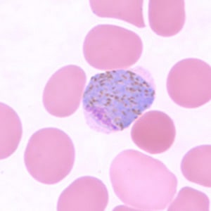Pv_gametocyte_thinF.jpg Figure H: Macrogametocyte of <em>P. vivax</em> in a thin blood smear.