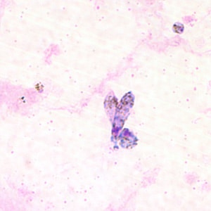 Pv_ookinete_thickB.jpg Figure B: Ookinete of <em>P. vivax</em> in a thick blood smear.
