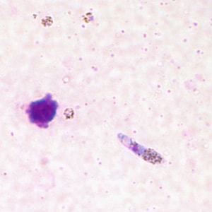 Pv_ookinete_thickC.jpg Figure C: Ookinete of <em>P. vivax</em> in a thick blood smear.
