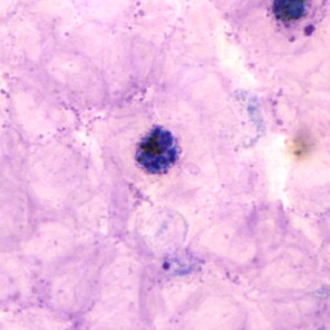 Pv_schizont_thickA.jpg Figure A: Schizont of <em>P. vivax</em> in a thick blood smear.