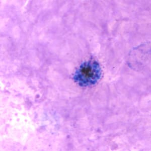Pv_schizont_thickB.jpg Figure B: Schizont of <em>P. vivax</em> in a thick blood smear.