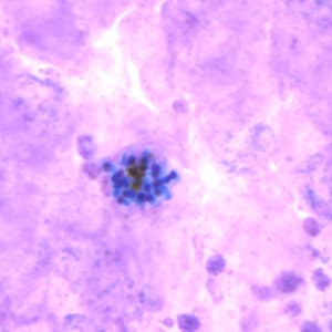 Pv_schizont_thickC.jpg Figure C: Schizont of <em>P. vivax</em> in a thick blood smear.