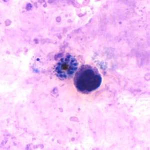Pv_schizont_thickD.jpg Figure D: Schizont of <em>P. vivax</em> in a thick blood smear.