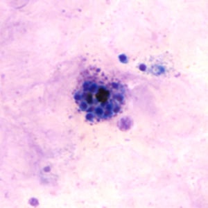 Pv_schizont_thickE.jpg Figure E: Schizont of <em>P. vivax</em> in a thick blood smear.