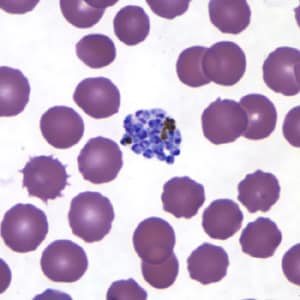 Pv_schizont_thinB.jpg Figure G: Schizont of <em>P. vivax</em> in a thin blood smear.