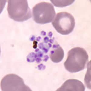 Pv_schizont_thinD.jpg Figure I: Ruptured schizont of <em>P. vivax</em> in a thin blood smear, showing free merozoites and pigment.
