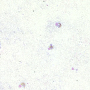 Pf_troph_thickA.jpg Figure A: Trophozoites of <em>P. falciparum</em> in a thick blood smear.