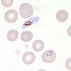 Pf_troph_thinC.jpg Figure D: Trophozoite of <em>P. falciparum</em> in a thin blood smear. In this figure, a gametocyte can also be seen in the upper half of the image.