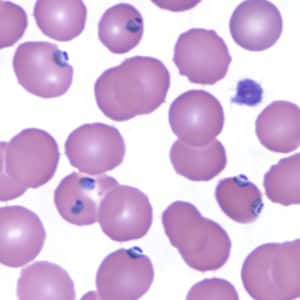 Pf_troph_thinE.jpg Figure F: Trophozoites of <em>P. falciparum</em> in a thin blood smear.