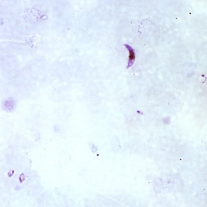 Pf_gametocyte_thickA.jpg Figure A: Gametocyte of <em>P. falciparum</em> in a thick blood smear. Note also the presence of many ring-form trophozoites.