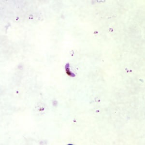 Pf_gametocyte_thickB.jpg Figure B: Gametocytes of <em>P. falciparum</em> in a thick blood smear. Note also the presence of many ring-form trophozoites.