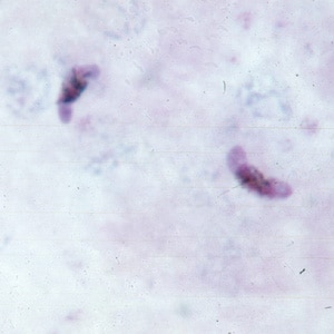 Pf_gametocyte_thickC.jpg Figure C: Gametocytes of <em>P. falciparum</em> in a thick blood smear.