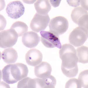 Pf_gametocyte_thinA.jpg Figure D: Gametocyte of <em>P. falciparum</em> in a thin blood smear. Also seen in this image are ring-form trophozoites and an RBC exhibiting basophilic stippling (upper left).