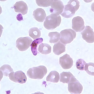 Pf_gametocyte_thinB.jpg Figure E: Gametocyte of <em>P. falciparum</em> in a thin blood smear. Also seen in this image are ring-form trophozoites exhibiting Maurer's clefts.
