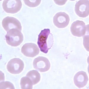 Pf_gametocyte_thinC.jpg Figure F: Gametocyte of <em>P. falciparum</em> in a thin blood smear. In these specimens, Laveran's bibs can be seen.