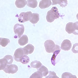 Pf_gametocyte_thinE.jpg Figure H: Gametocyte of <em>P. falciparum</em> in a thin blood smear, showing Laveran's bib. Also seen in this image are ring-form trophozoites exhibiting Maurer's clefts.