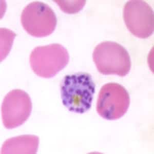 Pf_schizont_thinC.jpg Figure C: Schizont of <em>P. falciparum</em> in a thin blood smear. Trophozoites are also seen in this image.