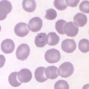 Pk_rings_thin_NY2.jpg Figure B: Ring-form trophozoite of <em>P. knowlesi</em> in a Giemsa-stained thin blood smear from a human patient that traveled to the Philippines. Image courtesy of the Wadsworth Center, New York State Department of Health.