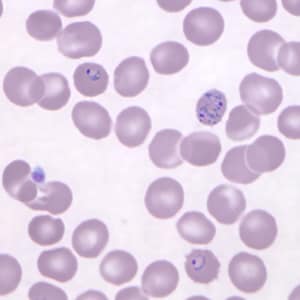 Pk_rings_thin_NY3.jpg Figure C: Ring-form trophozoites of <em>P. knowlesi</em> in a Giemsa-stained thin blood smear from a human patient that traveled to the Philippines. Note a multiply-infected RBC in this image. Image courtesy of the Wadsworth Center, New York State Department of Health.