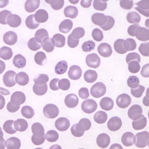 Pk_rings_thin_NY6.jpg Figure F: Ring-form trophozoites of <em>P. knowlesi</em> in a Giemsa-stained thin blood smear from a human patient that traveled to the Philippines. Note a multiply-infected RBC in this image. Image courtesy of the Wadsworth Center, New York State Department of Health.