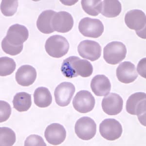 Pk_gametocyte_thin_NY2.jpg Figure B: Gametocyte of <em>P. knowlesi</em> in a Giemsa-stained thin blood smear from a patient that traveled to the Philippines. Note also a ring-form trophozoite in the lower left of this image. Image courtesy of the Wadsworth Center, New York State Department of Health.