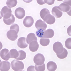 Pk_schizont_thin_NY3.jpg Figure C: Developing schizont in a Giemsa-stained thin blood smear from the same patient seen in Figures A and B.
