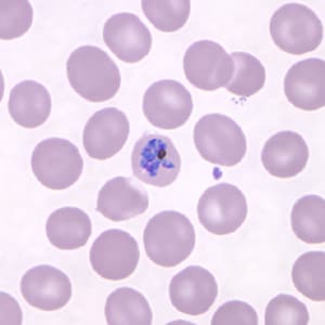 Pk_schizont_thin_NY4.jpg Figure D: Mature schizont in a Giemsa-stained thin blood smear from the same patient seen in Figures A-C.