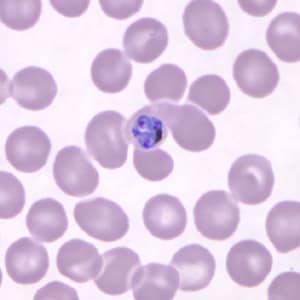 Pk_schizont_thin_NY5.jpg Figure E: Developing schizont in a Giemsa-stained thin blood smear from the same patient as Figures A-D.