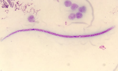 M_perstans_Canada.jpg Figure F: Microfilaria of <em>M. perstans</em> in a thick blood smear stained with Giemsa. Image courtesy of the Parasitology Department, Public Health Lab, Ontario Agency for Health Protection and Promotion, Canada.