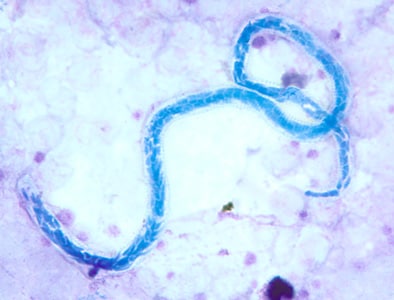 M_perstans_thick_BAM1.jpg Figure A: Microfilaria of <em>M. perstans</em> in a thick blood smear stained with Giemsa, from a patient from Cameroon.