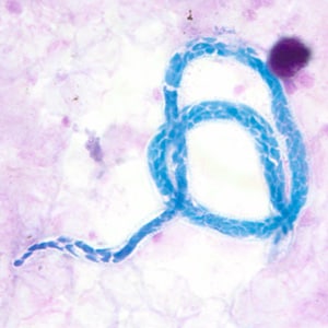 M_perstans_thick_BAM2.jpg Figure B: Microfilaria of <em>M. perstans</em> in a thick blood smear stained with Giemsa, from a patient from Cameroon.
