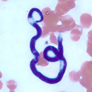 M_perstans_thin_BAM2.jpg Figure E: Microfilaria of <em>M. perstans</em> in a thin blood smear from the same specimen as Figures A-D.