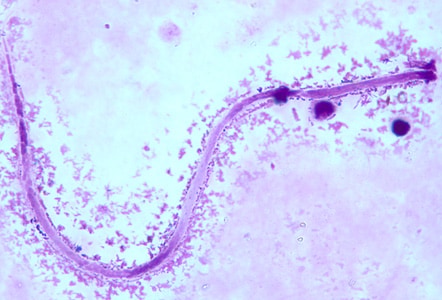 M_ozzardi_BAM1.jpg Figure A: Microfilaria of <em>M. ozzardi</em> in a thick blood smear, stained with Giemsa.