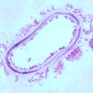 M_ozzardi_BAM2.jpg Figure B: Microfilaria of <em>M. ozzardi</em> in a thick blood smear, stained with Giemsa.