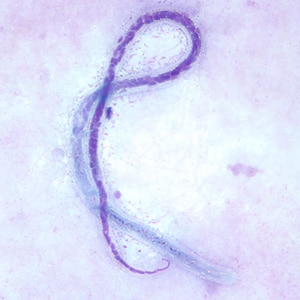 M_ozzardi_BAM4.jpg Figure D: Microfilaria of <em>M. ozzardi</em> in a thick blood smear, stained with Giemsa. Note the hook-like end to the tail in this figure.