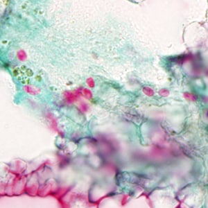 Tub_acrid_NIH_2012a.jpg Figure A: Spores of <em>T. acridophagus</em> in BAL specimens, stained with Chromotrope 2R stain.