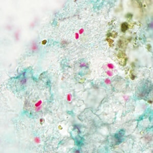 Tub_acrid_NIH_2012b.jpg Figure B: Spores of <em>T. acridophagus</em> in BAL specimens, stained with Chromotrope 2R stain.
