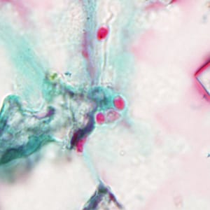 Tub_acrid_NIH_2012c.jpg Figure C: Spores of <em>Tubulinosema acridophagus</em> in (BAL) specimens, stained with Chromotrope 2R stain.