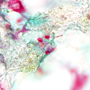 Tub_acrid_NIH_2012d.jpg Figure D: Spores of <em>Tubulinosema acridophagus</em> in (BAL) specimens, stained with Chromotrope 2R stain.