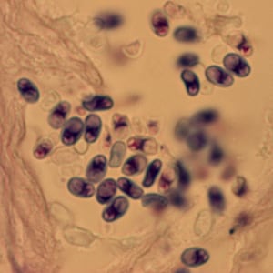 msp_Sweden1.jpg Figure A: Microsporidia spores from a corneal section, stained with Giemsa.