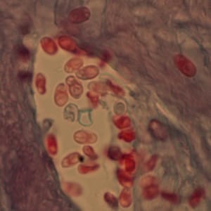 msp_Sweden3.jpg Figure C: Microsporidia spores from a corneal section, stained with trichrome.