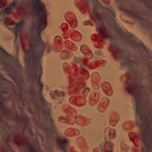 msp_Sweden4.jpg Figure D: Microsporidia spores from a corneal section, stained with trichrome.