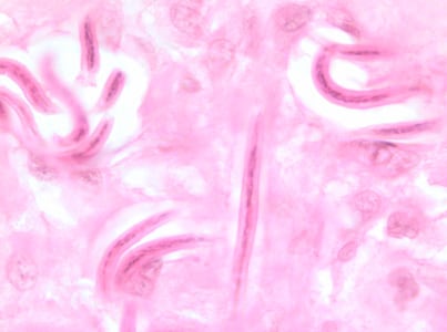 Figure A: Microfilariae of <em>O. volvulus</em> from a skin nodule of a patient from Zambia, stained with hematoxylin and eosin (H&E). Image taken at 1000x oil magnification.