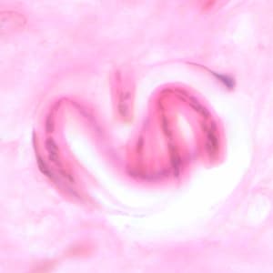 Figure D: Coiled microfilaria of <em>O. volvulus</em>, in a skin nodule from a patient from Zambia, stained with H&E. Image taken at 1000x oil magnification.