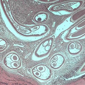 Figure A: Adult of <em>O. volvulus</em> in a subcutaneous nodule, stained with hematoxylin and eosin (H&E).