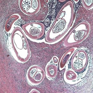 Figure B: Adult of <em>O. volvulus</em> in a subcutaneous nodule, stained with hematoxylin and eosin (H&E).