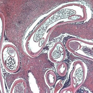 Figure C: Adult of <em>O. volvulus</em> in a subcutaneous nodule, stained with H&E.