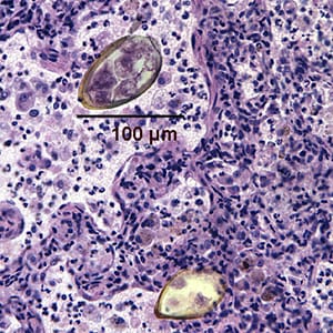 Paragonimus_egg_lung_biopsy1.jpg Figure A: Eggs of <em>Paragonimus</em> sp. taken from a lung biopsy stained with hematoxylin and eosin (H&E). These eggs measured 80-90 µm by 40-45 µm. The species was not identified in this case.