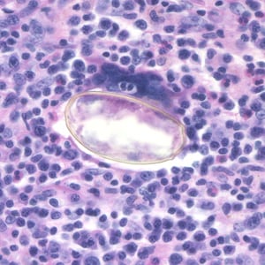 Paragonimus_egg_lung_biopsy2.jpg Figure B: Egg of <em>Paragonimus</em> sp. taken from a lung biopsy stained with hematoxylin and eosin (H&E). This egg measured 80-90 µm by 40-45 µm. The species was not identified in this case.